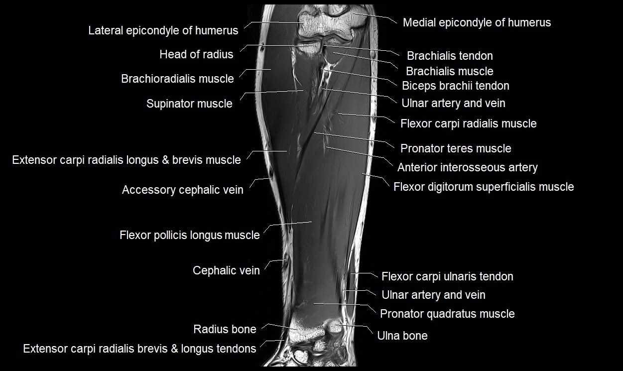 MRI 3T forearm coronal cross sectional anatomy image 12.webp